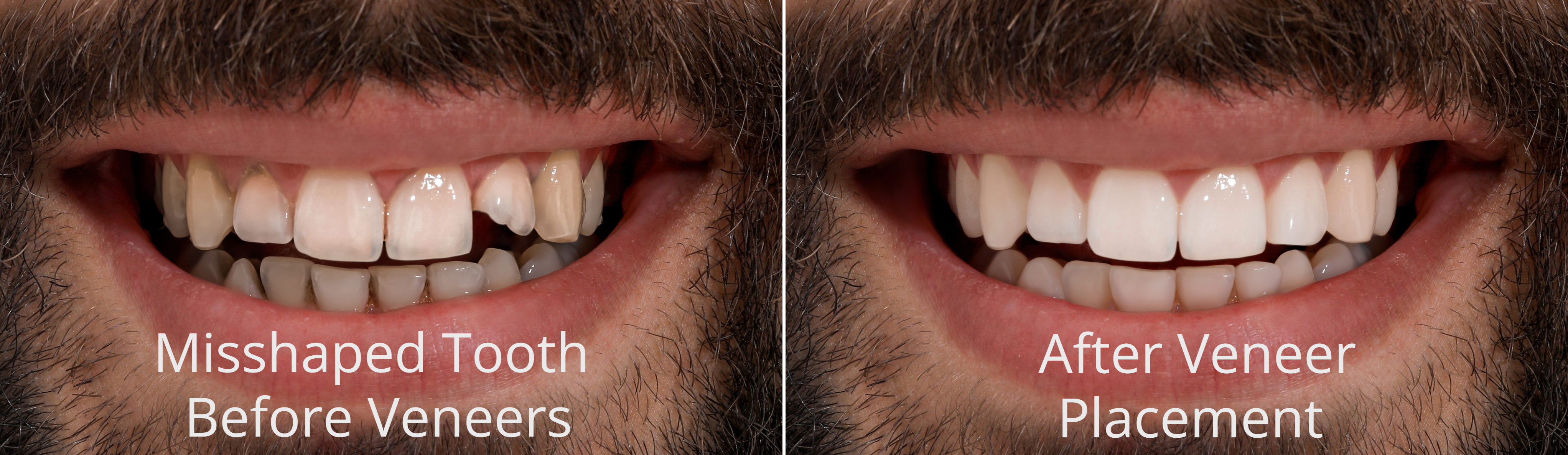 Dental Veneer Before and After- Misshaped