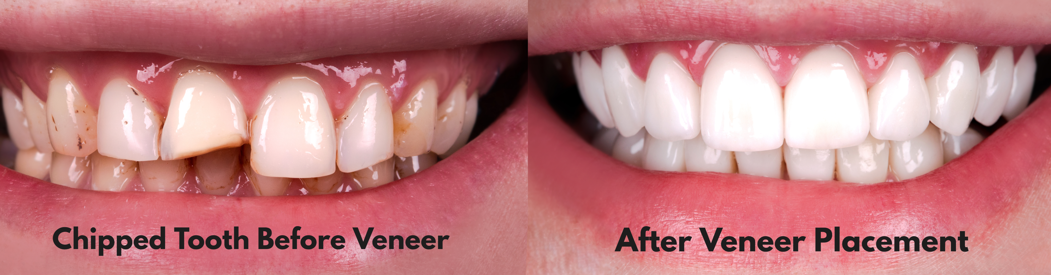 Dental Veneers Before and After