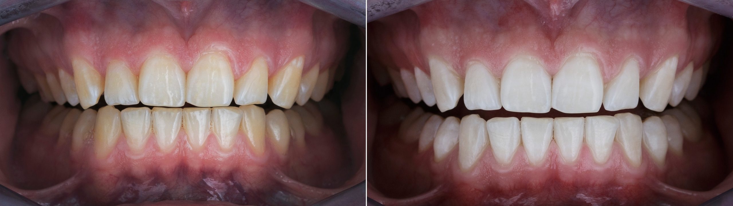 dental photo comparison before and after teeth whitening