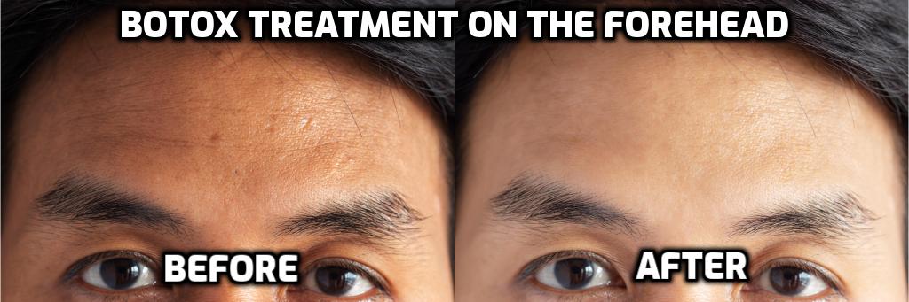 Botox Treatement on the Forehead