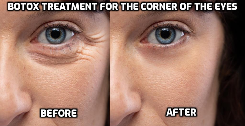 Botox Treatment for Crowsfeet