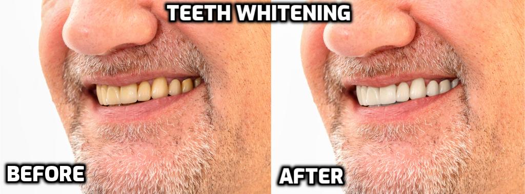 Dental Veneers Before and After