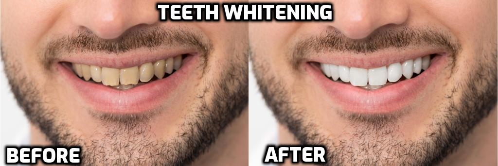 Teeth Whitening Picture Before and After