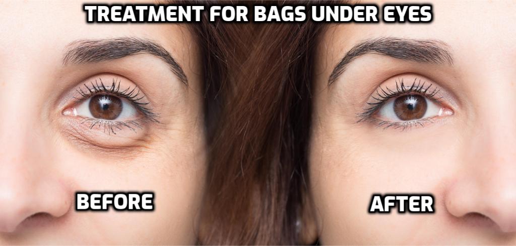 Treatment for Bags Under the Eyes